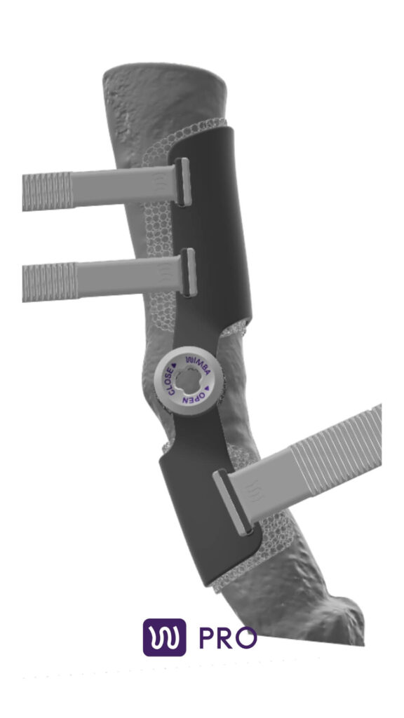 3d model of the limb with wimba orthosis