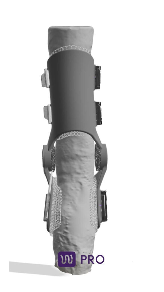 3d model of the limb with wimba orthosis