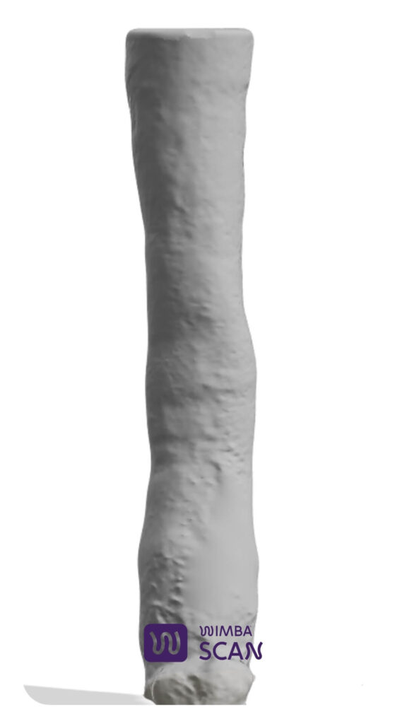 3d model of the limb with wimba orthosis