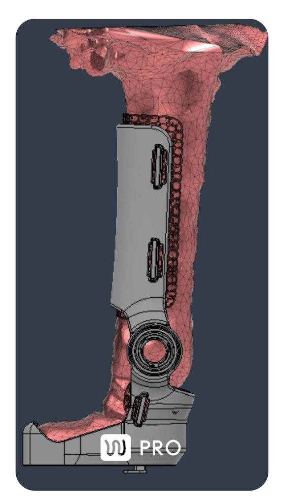 3d model of the limb with wimba orthosis