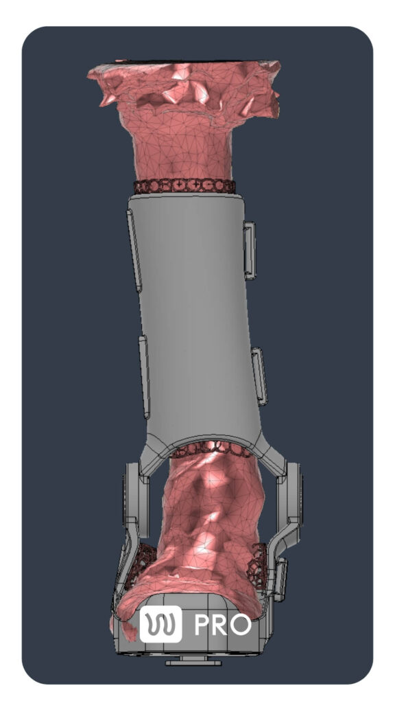 3d model of the limb with wimba orthosis
